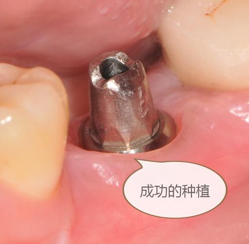 植牙骨后有洼坑正常吗-图3