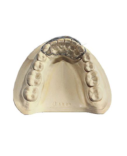 牙齿正畸装弹簧,究竟有何矫正妙用?-图2 牙齿正畸装弹簧,究竟有何矫正妙用?-图2