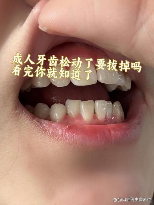 正畸的时候龋齿松动-图1