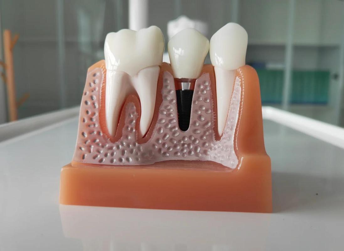 种植牙植体最窄直径能到几毫米？有没有超窄型号可选？-图1