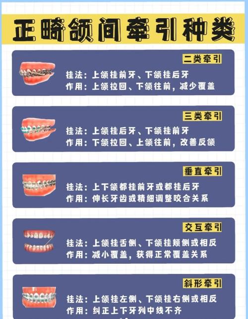 正畸颌间343牵引，343代表什么？牵引机制与效果如何？-图3