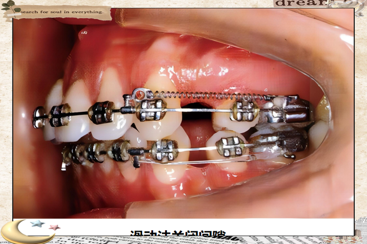 正畸正轴簧安装视频-图3
