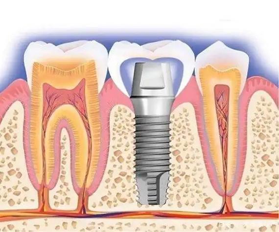 all-on4种植牙-图1