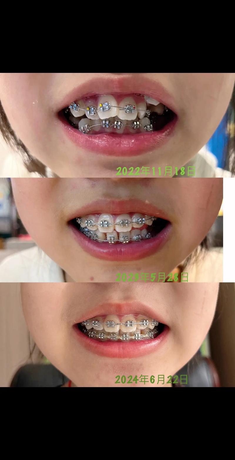 正畸后保持器 更换-图3