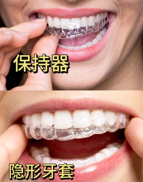 正畸后保持器 更换-图2