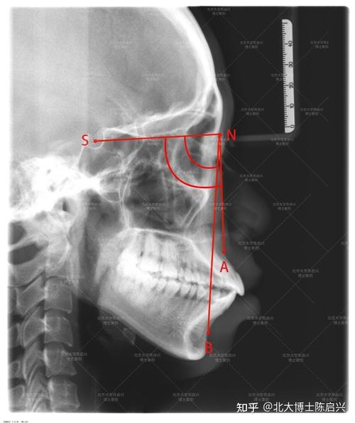 正畸anb角是什么-图3