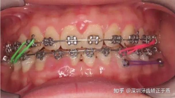 正畸颌间牵引分几类-图3 正畸颌间牵引分几类-图3
