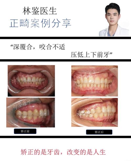 牙齿稀疏正畸要多久-图2