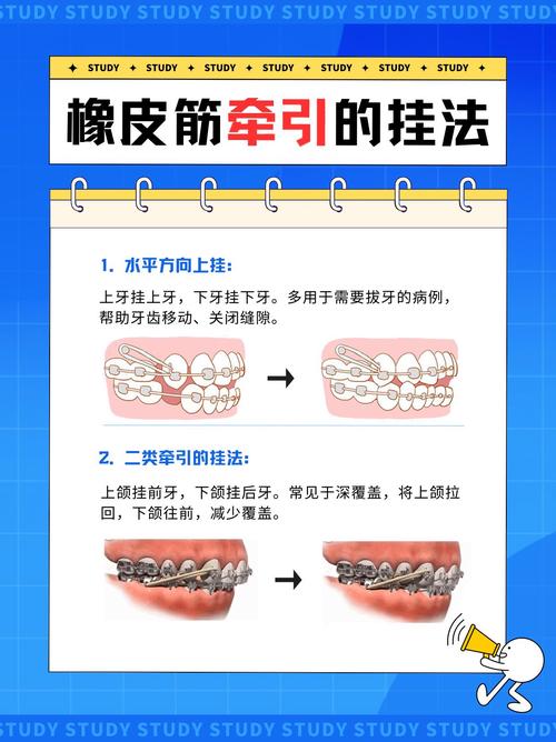 正畸垂直牵引的步骤-图1