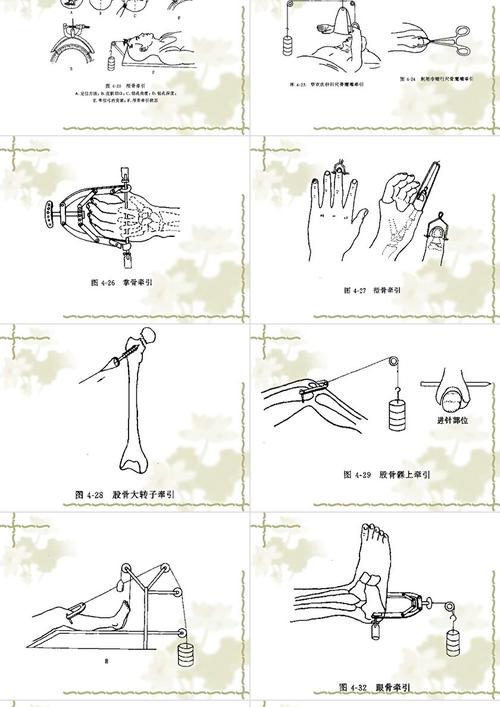 正畸垂直牵引的步骤-图2