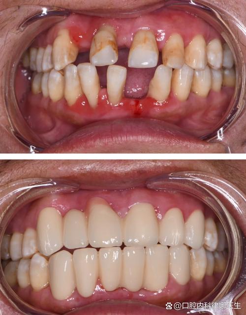 做了烤瓷牙还能做正畸矫正吗？-图3
