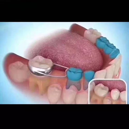 正畸带环最常用型号-图3