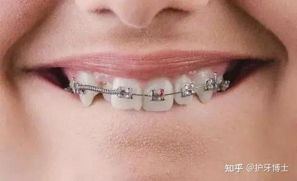 20岁正畸效果如何？这个年龄矫正会比小时候差吗？-图1