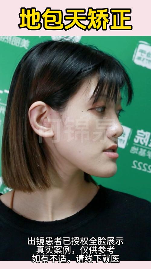 20岁正畸效果如何？这个年龄矫正会比小时候差吗？-图3