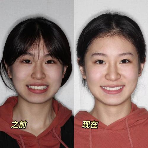 杭州龅牙正畸哪里好-图1