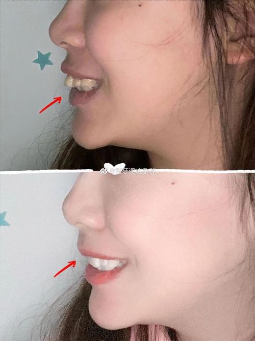 杭州龅牙正畸哪里好-图3