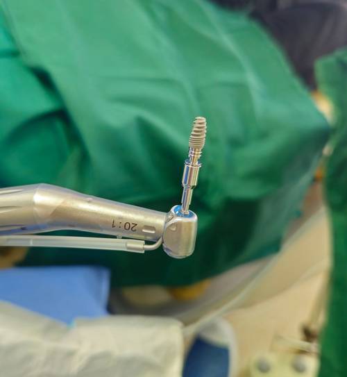 植牙种植体螺纹有问题?安全隐患何在?如何应对?-图1 植牙种植体螺纹有问题?安全隐患何在?如何应对?-图1