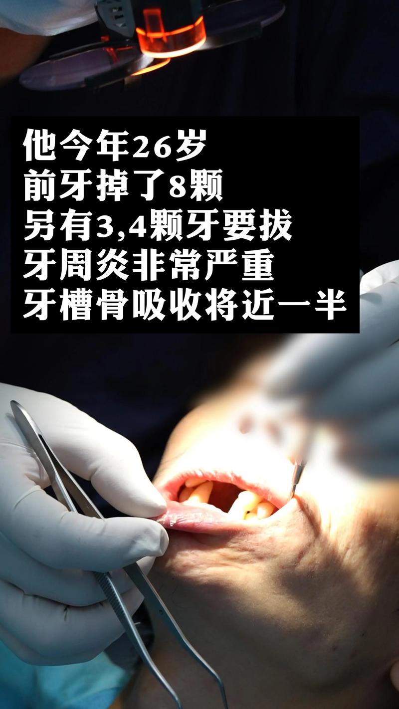 植牙种植体螺纹有问题?安全隐患何在?如何应对?-图3 植牙种植体螺纹有问题?安全隐患何在?如何应对?-图3