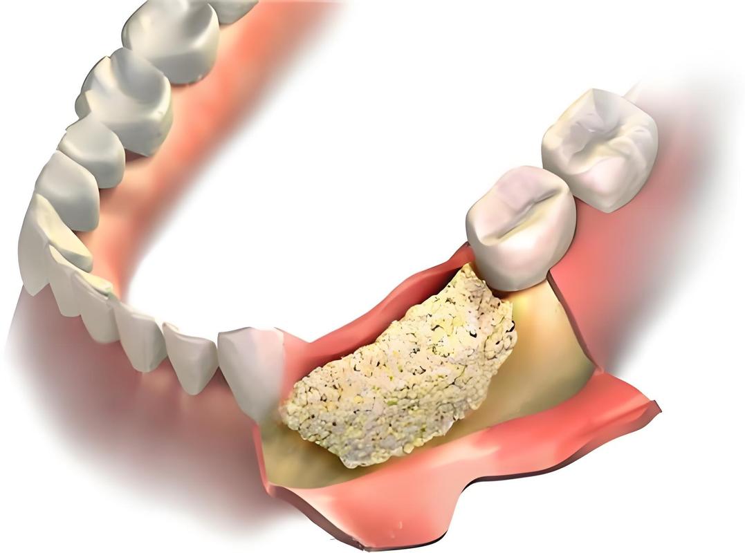 骨缺损种植牙植体高度-图3 骨缺损种植牙植体高度-图3