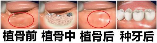 牙齿种植牙植骨是什么-图2
