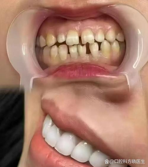 正畸牙缝不能关闭了-图3 正畸牙缝不能关闭了-图3