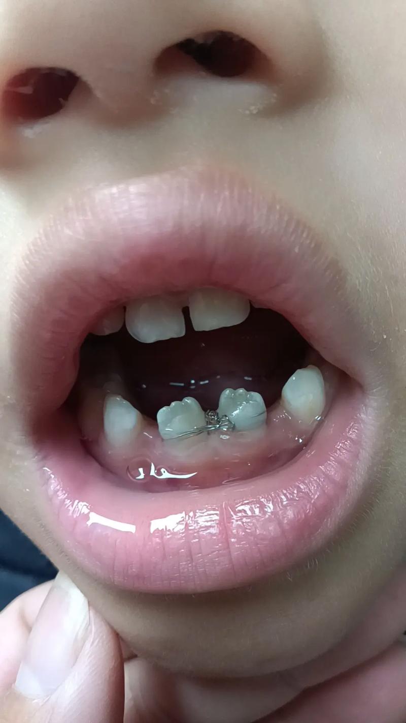 正畸牙缝不能关闭了-图2 正畸牙缝不能关闭了-图2