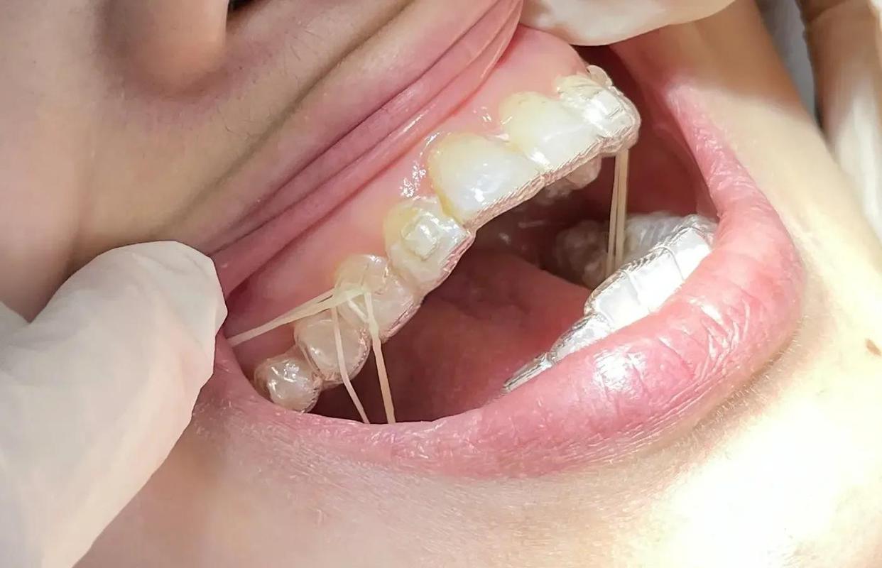 正畸挂皮筋多久手术-图2