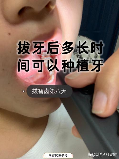 种牙植体伤口愈合需多久?术后恢复周期多长?-图3 种牙植体伤口愈合需多久?术后恢复周期多长?-图3