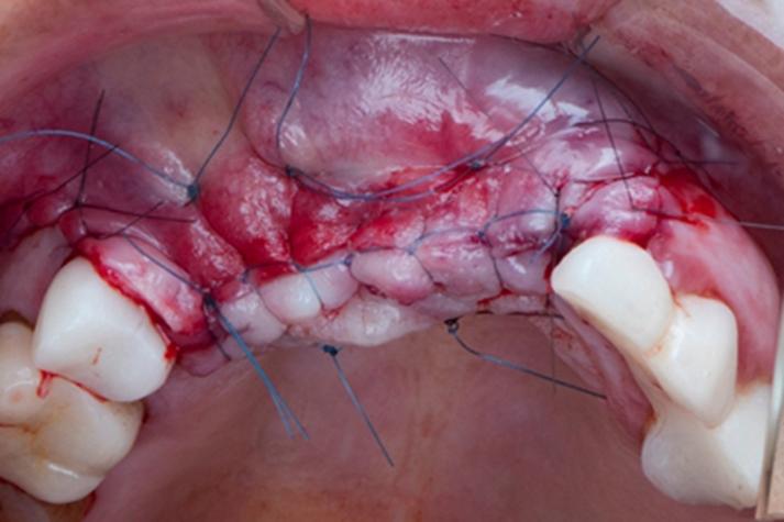 种牙植体伤口愈合需多久?术后恢复周期多长?-图2 种牙植体伤口愈合需多久?术后恢复周期多长?-图2