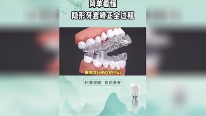 无托槽隐形正畸视频能真实展示矫正效果与过程吗？-图3