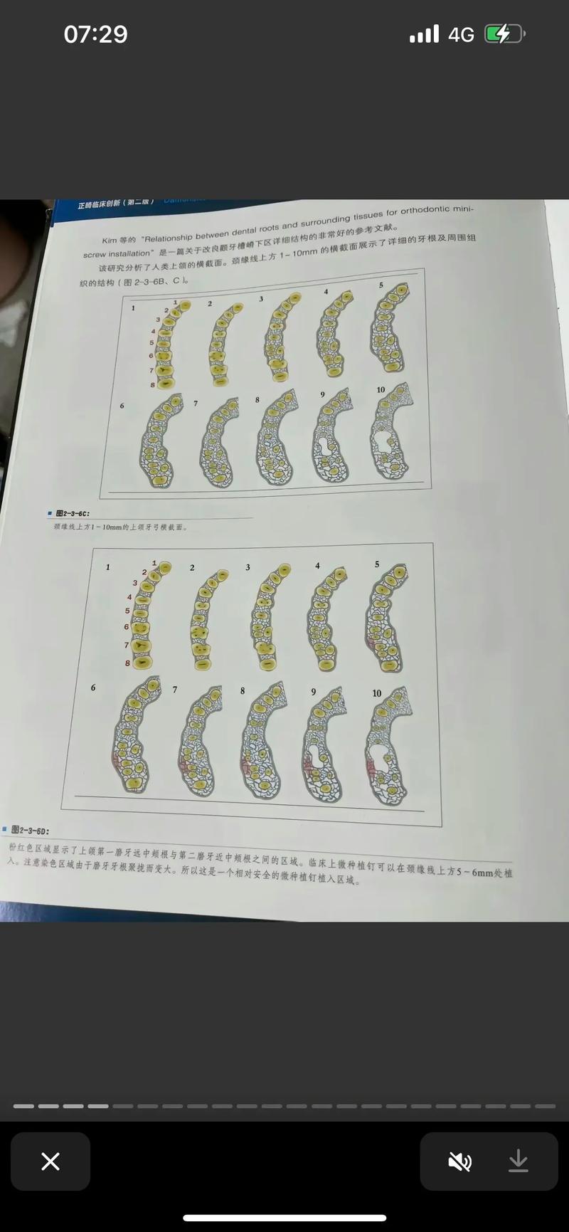 正畸支抗钉常用型号-图1