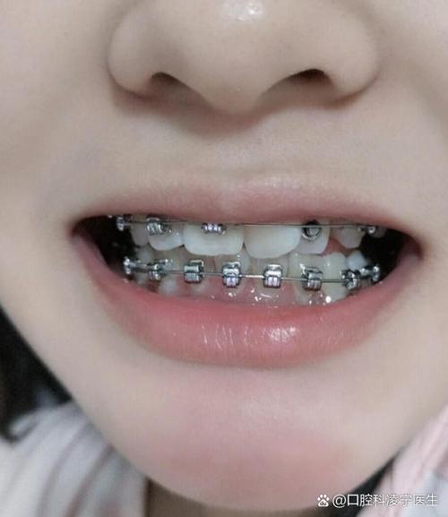丹东儿童正畸那最好-图3 丹东儿童正畸那最好-图3