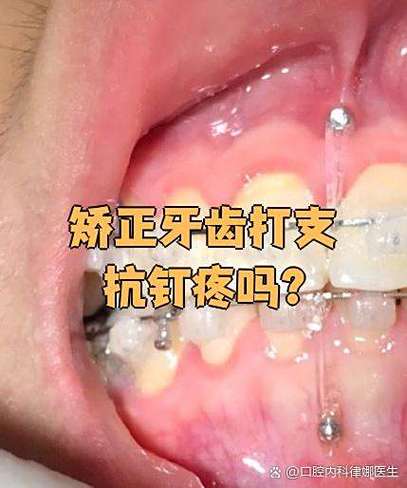 正畸支抗钉植入视频-图1