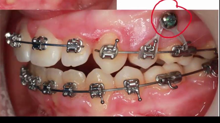 正畸支抗钉植入视频-图3