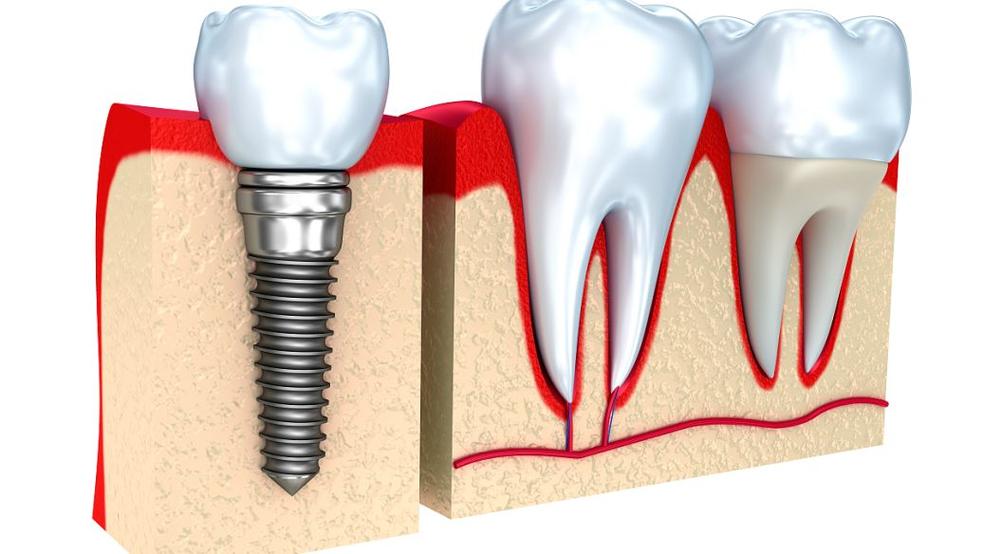 种牙植骨人工骨粉来自-图3