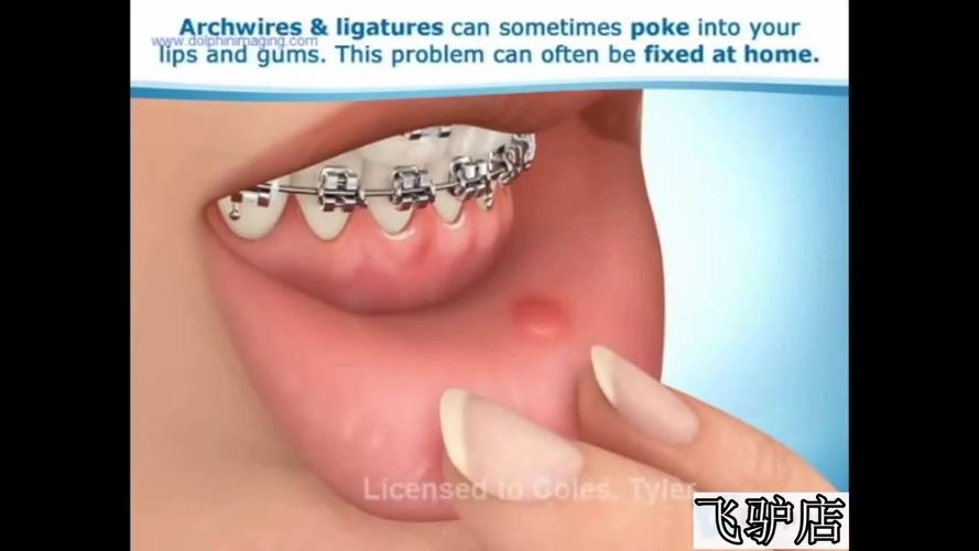 带着正畸保护蜡睡觉-图3 带着正畸保护蜡睡觉-图3