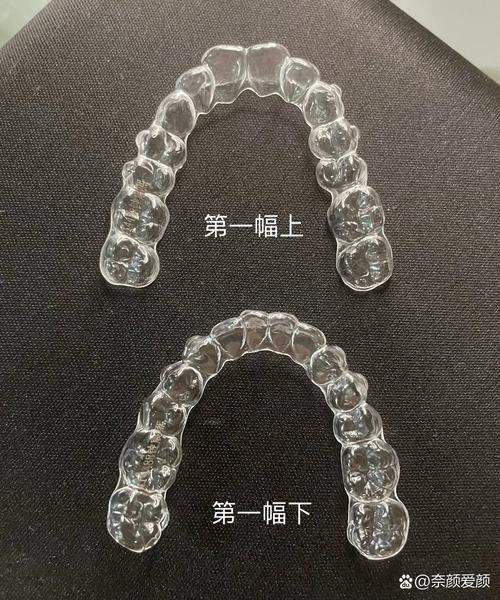 透明牙套正畸效果如何？哪些情况适合选择？-图1