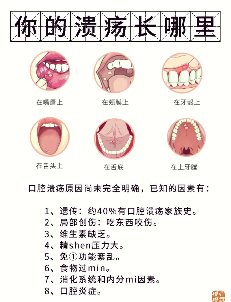 口腔有溃疡可以植牙吗-图2