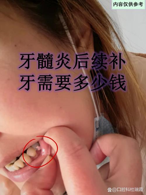 老人补牙好还是植牙好-图2