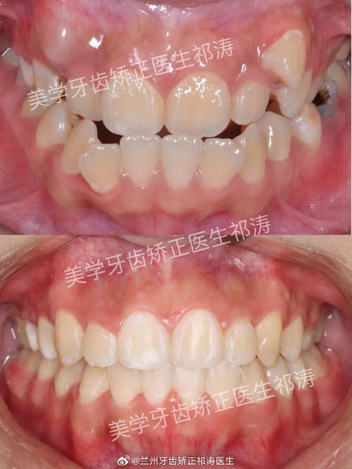 牙齿不齐拔除后正畸-图1