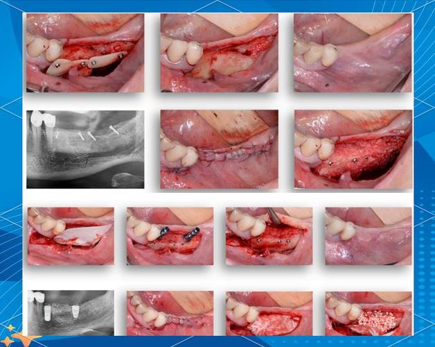 植牙时用了骨粉的反应-图2
