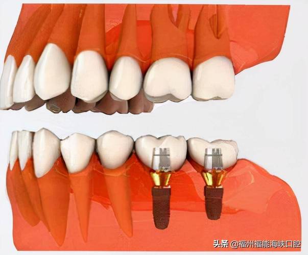 种植牙需要植体露出吗-图3 种植牙需要植体露出吗-图3