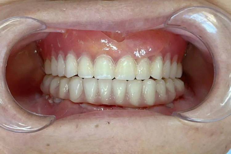 种植牙需要植体露出吗-图2 种植牙需要植体露出吗-图2