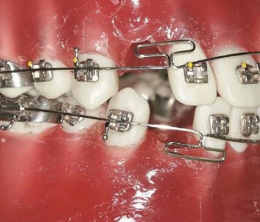 正畸meaw弓弯制的技巧与难点有哪些？-图1