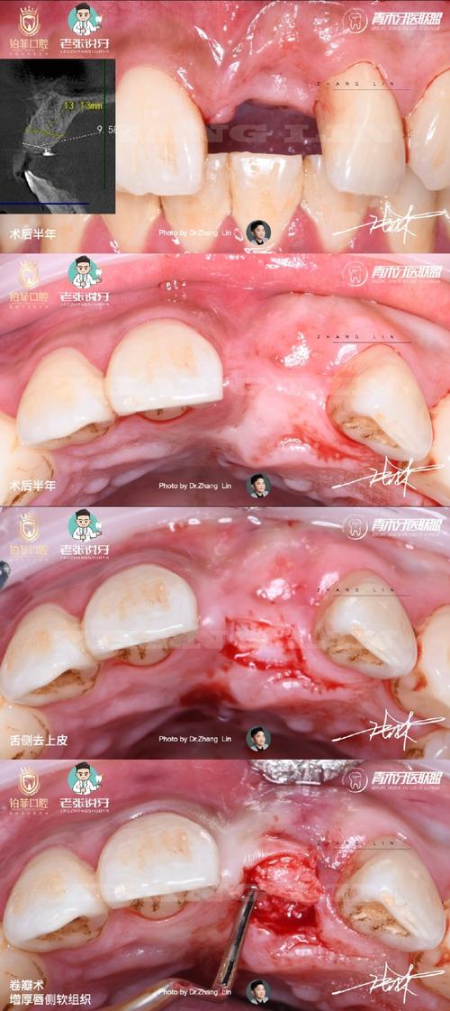 种植牙植骨粉失败会有哪些表现？-图3