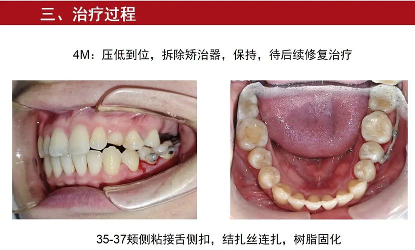 正畸支抗失控会有哪些具体表现？-图2