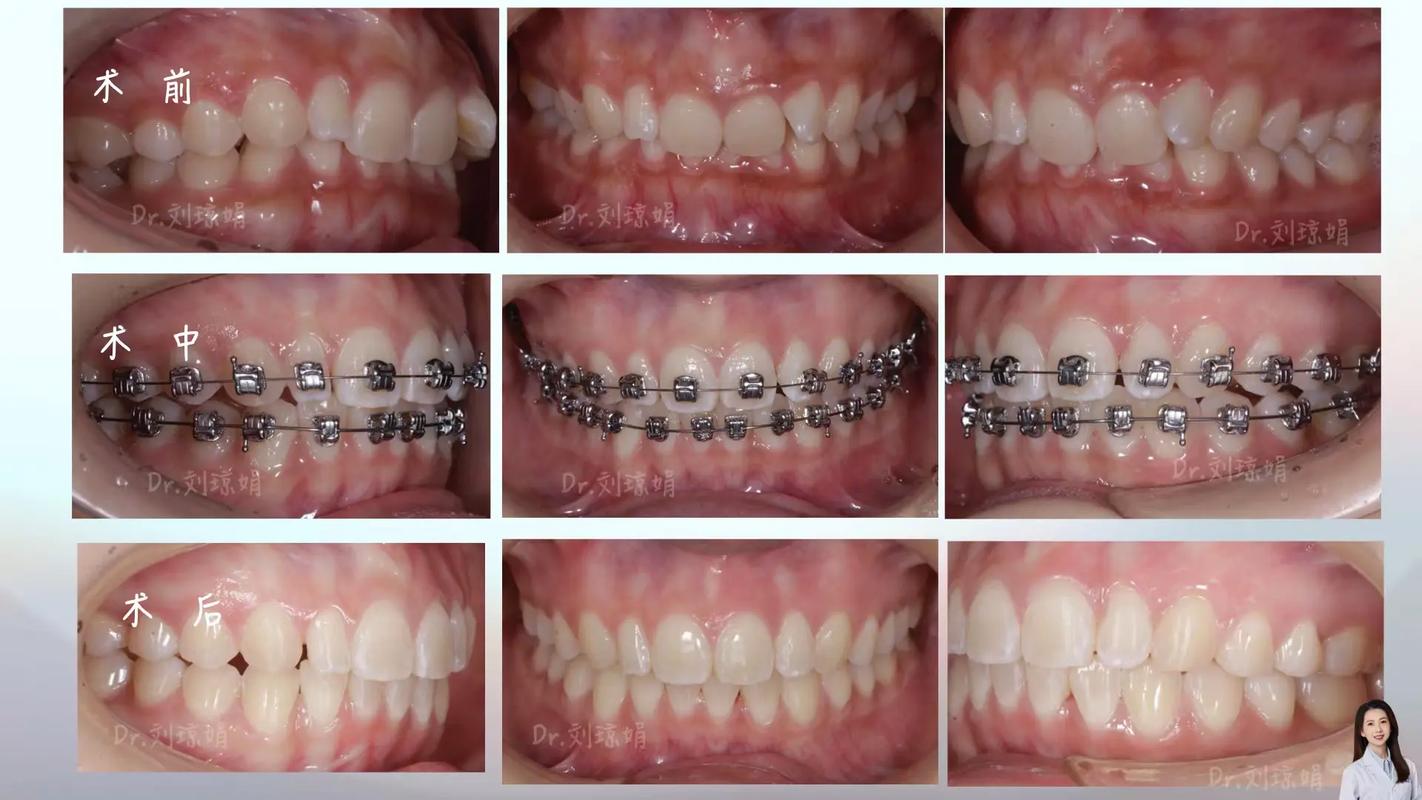 正畸支抗失控会有哪些具体表现？-图3