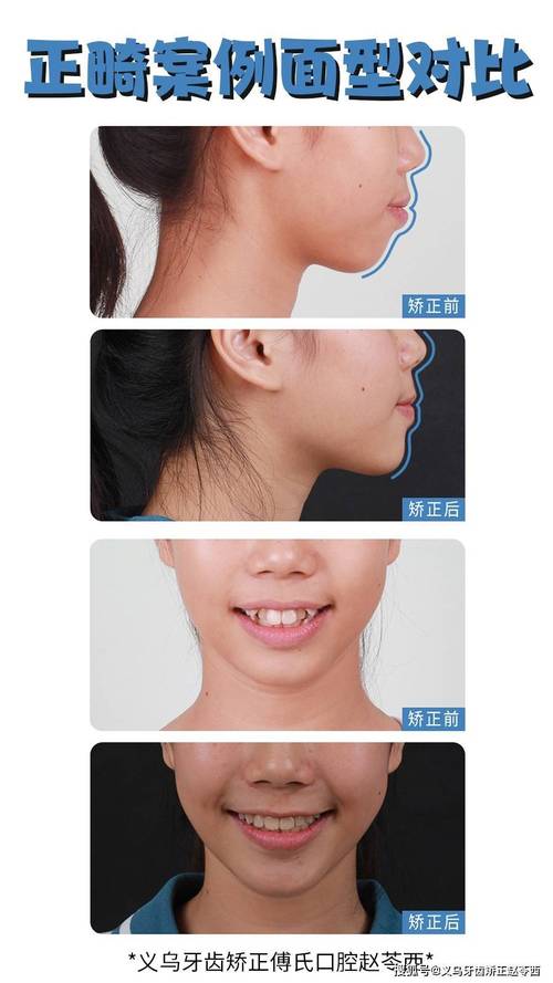 牙齿正畸能矫正侧牙不齐吗?-图1 牙齿正畸能矫正侧牙不齐吗?-图1