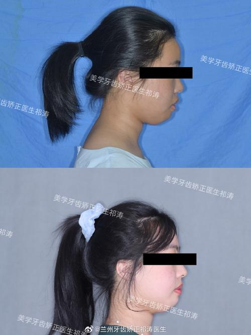 牙齿正畸能矫正侧牙不齐吗?-图3 牙齿正畸能矫正侧牙不齐吗?-图3