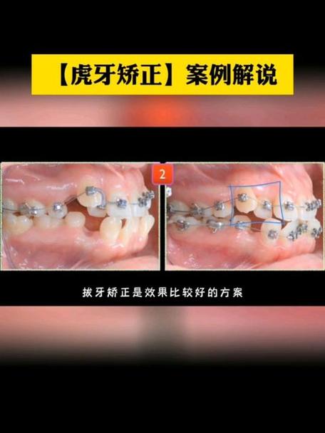 虎牙是乳牙怎么正畸-图2